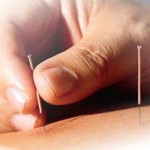 acupuncture